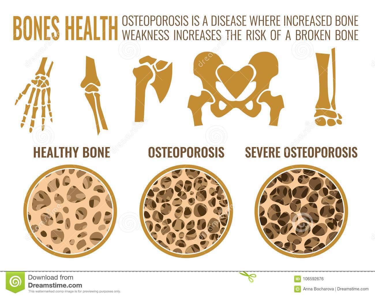Beat Osteoporosis with Exercise - Physio Pooja