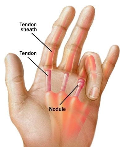trigger-finger-thumb-pain1