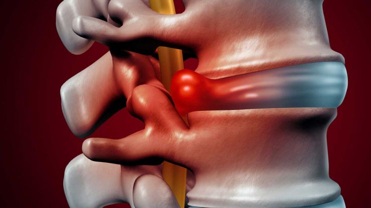 Ruptured disc